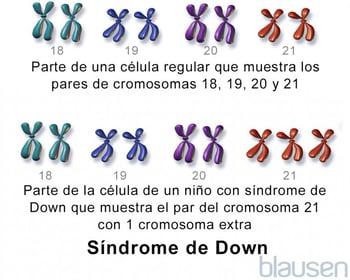 Síndrome de Down; trisomía 21