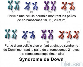 Syndrome de Down : Trisomie 21