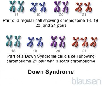 다운 증후군: 21번 삼염색체증