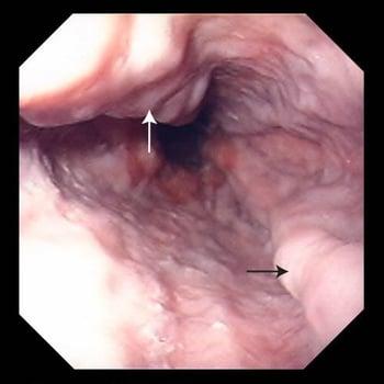 Vene dilatate nell’esofago (varici esofagee)