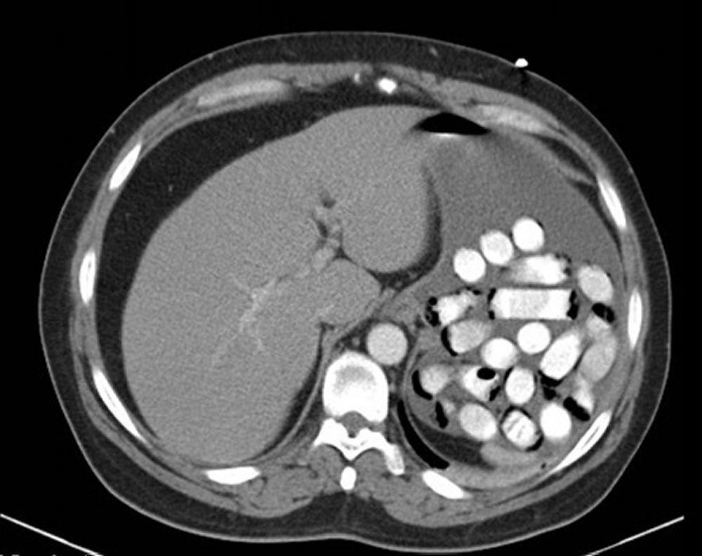 Инородное тело в желудке (снимок, сделанный при помощи компьютерной томографии)
