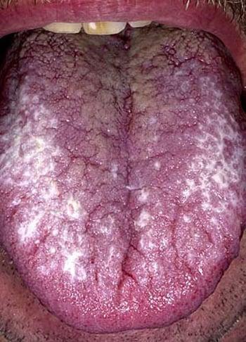 口腔内の扁平苔癬