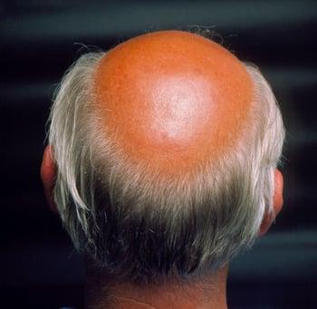 الثَّعلبة ذكريَّة الشَّكل Androgenetic alopecia