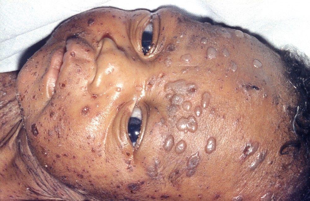 Blister Rash in Herpes Simplex Virus Infection