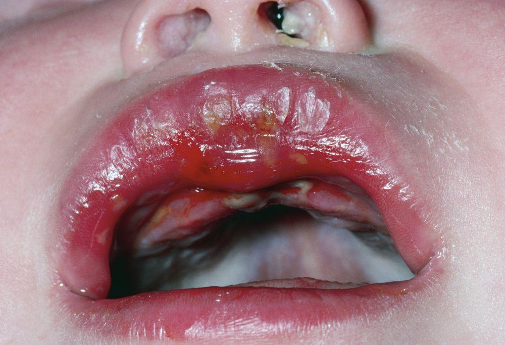 Úlceras na boca em infecção por vírus do herpes simples