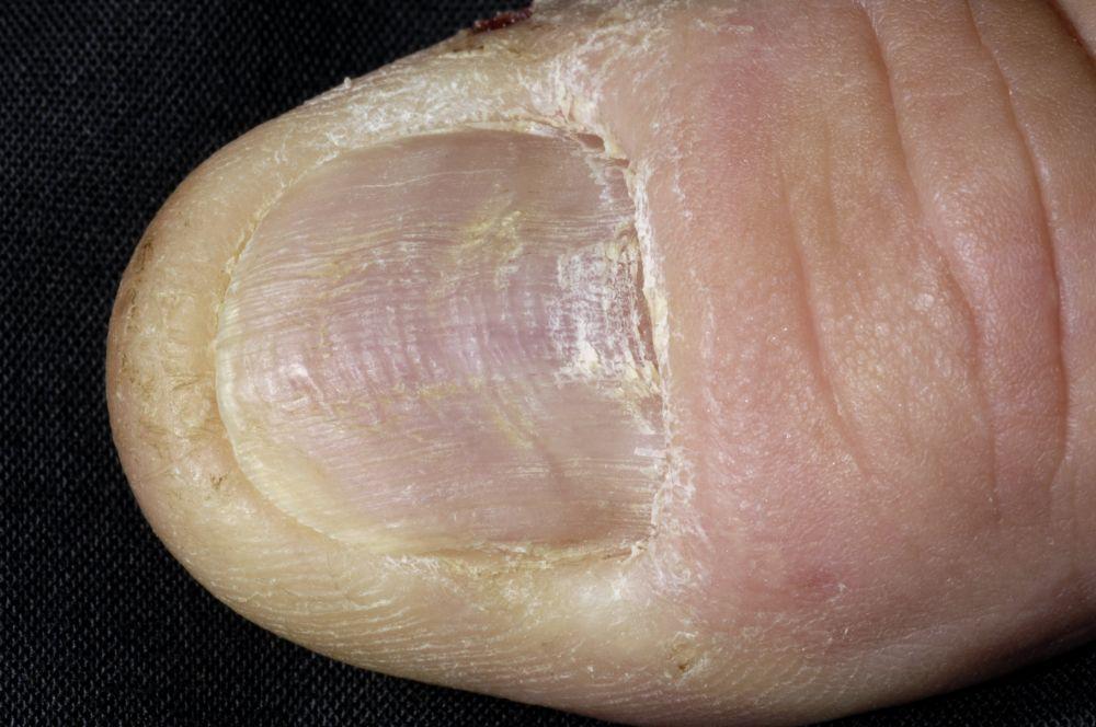 爪の扁平苔癬