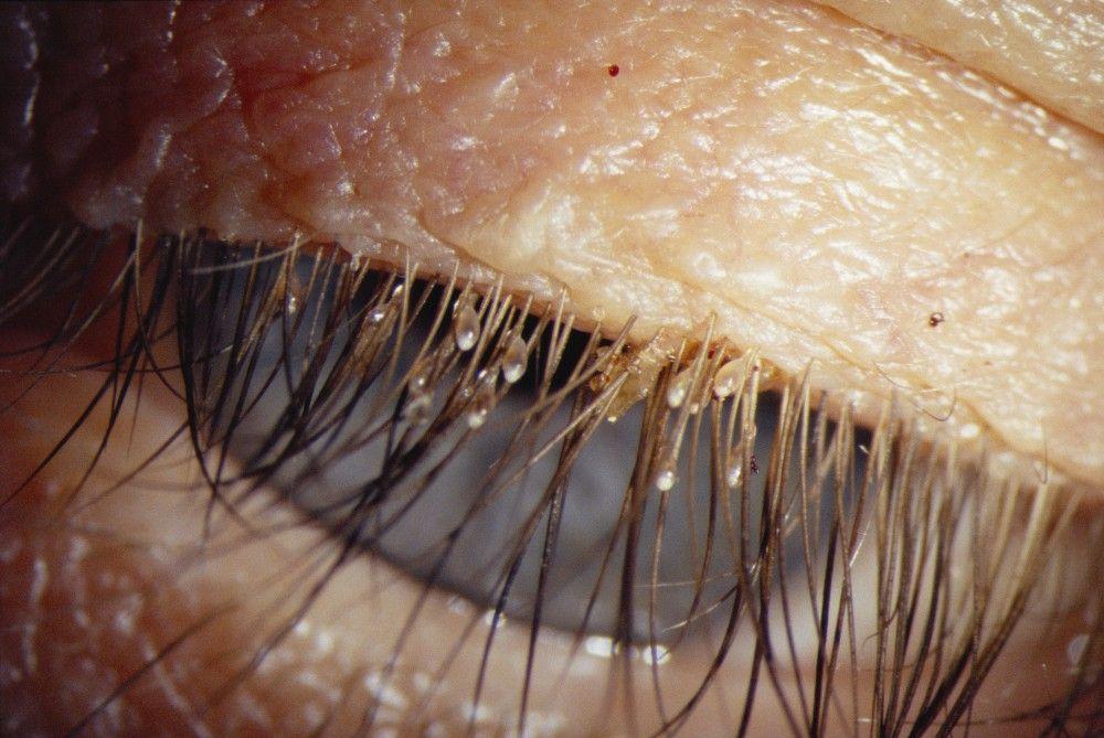 Lice on Eyelashes