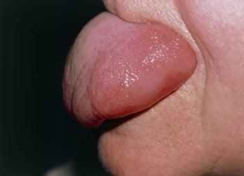 Angioedema de la lengua