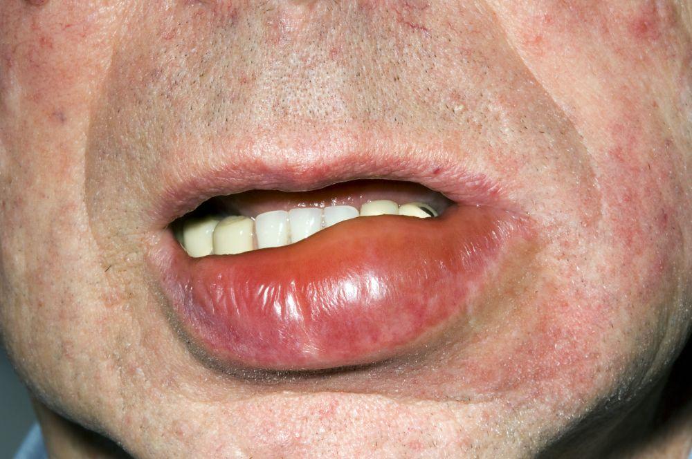 Angioedema dos lábios