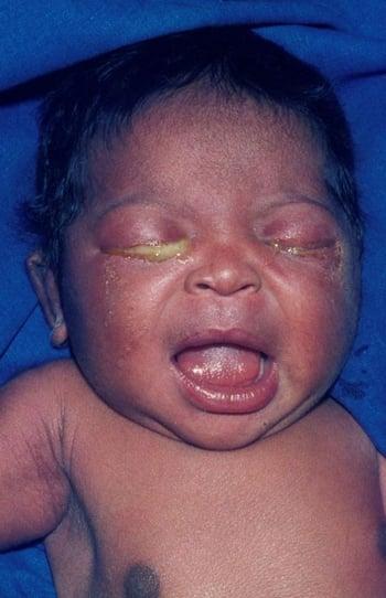 التهاب الملتحمة عند حديثي الولادة