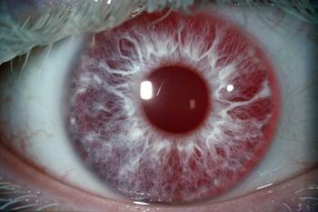Альбинизм (глазные симптомы)