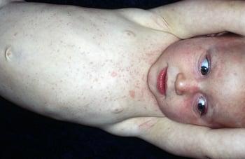 Eruzione cutanea causata dalla roseola infantum