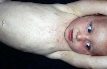 Сыпь, вызванная младенческой розеолой