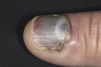 Подногтевая гематома (ногти на руках)