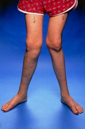 Х-образное искривление ног (вальгусная деформация коленных суставов)