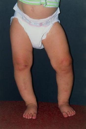 О-образное искривление ног (варусная деформация коленных суставов)