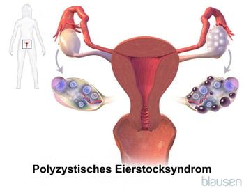 Polyzystisches Ovarialsyndrom (PCOS)