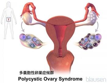 多嚢胞性卵巣症候群（PCOS）