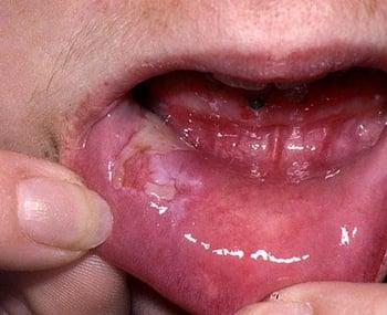 Pênfigo vulgar (úlceras na boca)