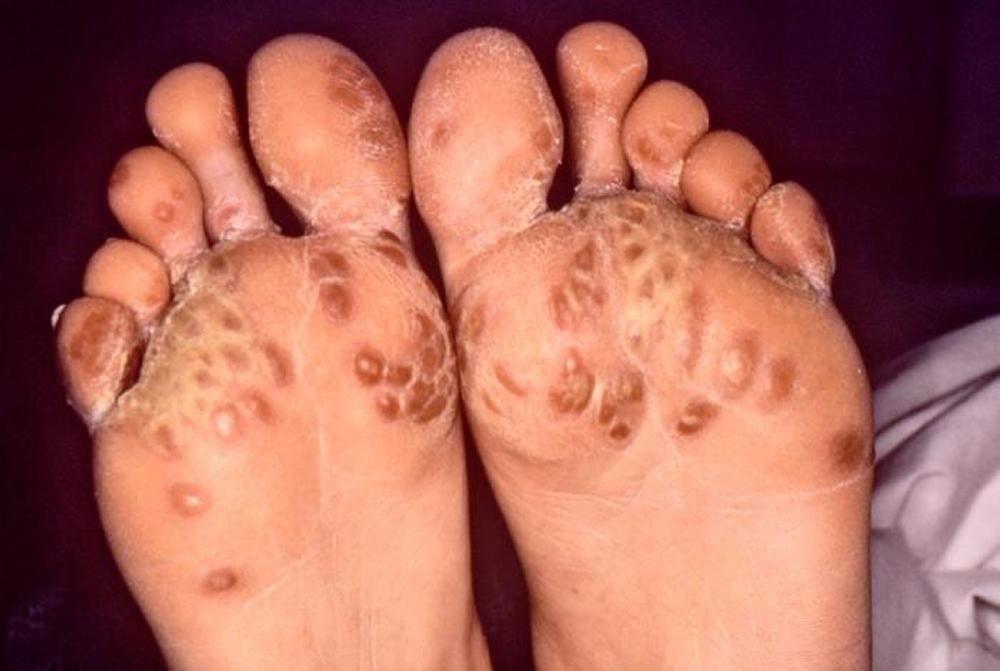 발에 영향을 미치는 반응성 관절염