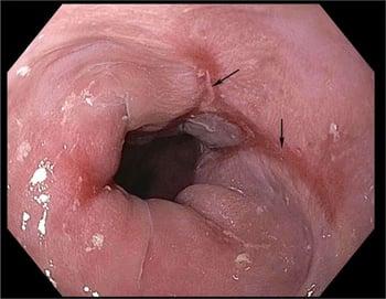 Erosive Esophagitis Caused by Gastroesophageal Reflux