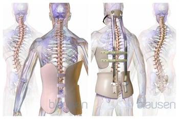 脊柱側弯症の装具
