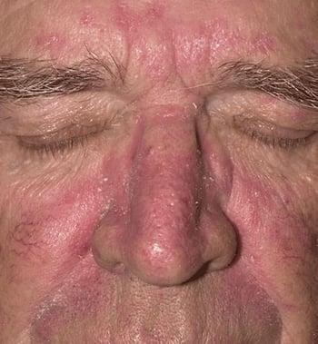 التهاب الجلد المثّي (الوجه)