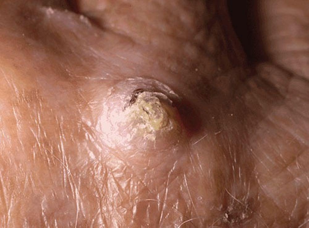 Carcinoma espinocelular