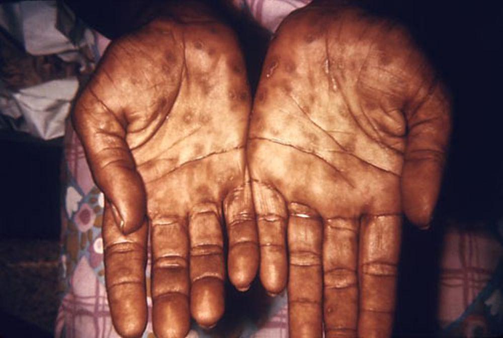 梅毒—第2期：手のひらの発疹