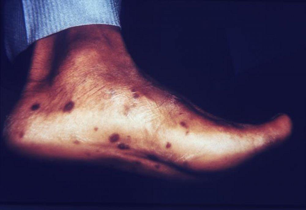 الزُهري- الثانوي : مُسببًا اندفاعًا جلديًا على باطن القدمين