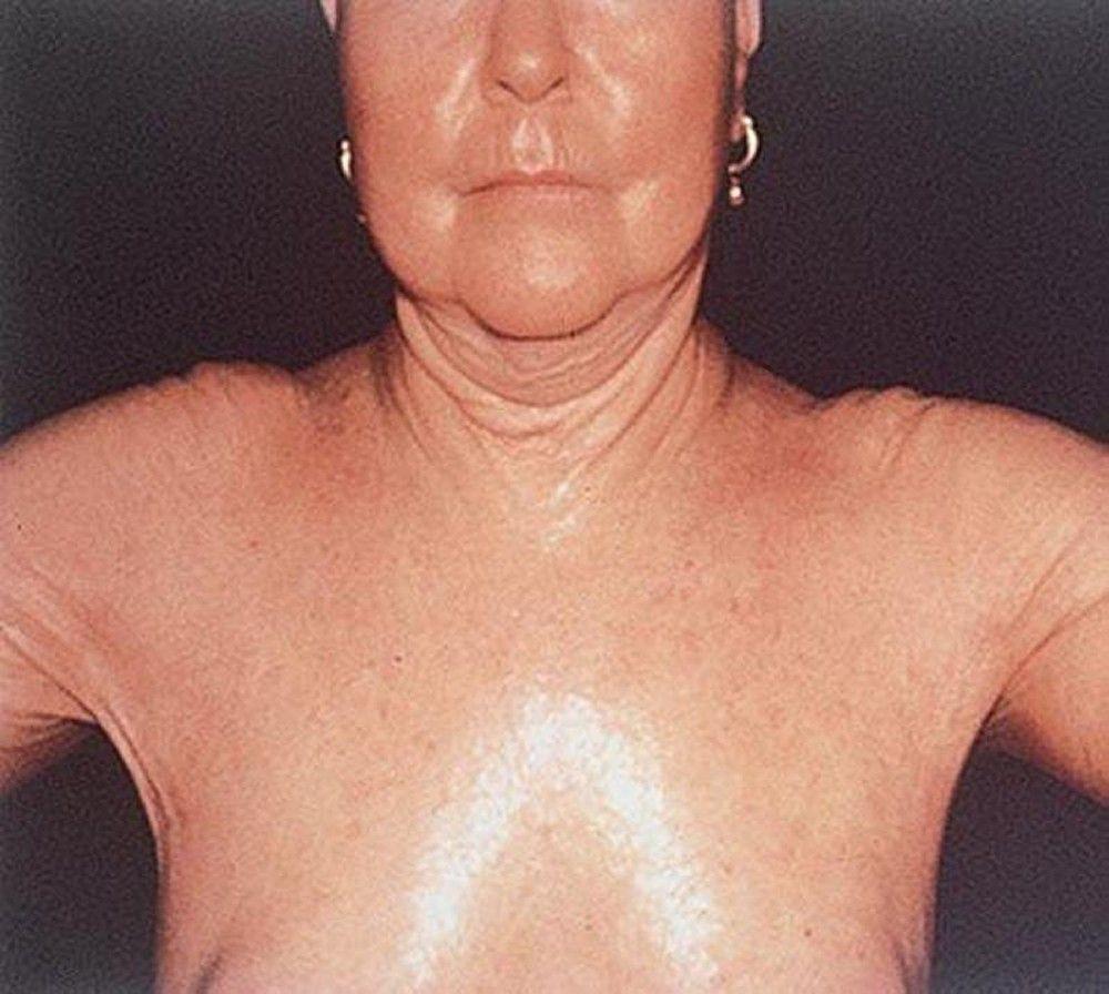 Diffuse Systemic Sclerosis Affecting the Chest and Shoulders