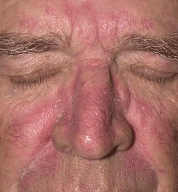 Dermatite seborroica (viso)