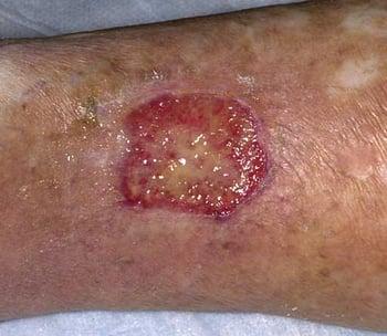 Dermatite da stasi (ulcera aperta)