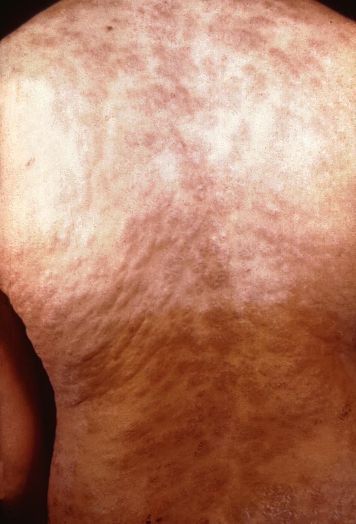 Sifilide secondaria: eruzione cutanea sulla schiena