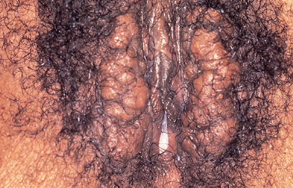 Epidermale Einschlusszysten der Vulva