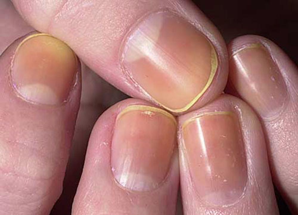Изменение цвета ногтей в результате использования лака для ногтей