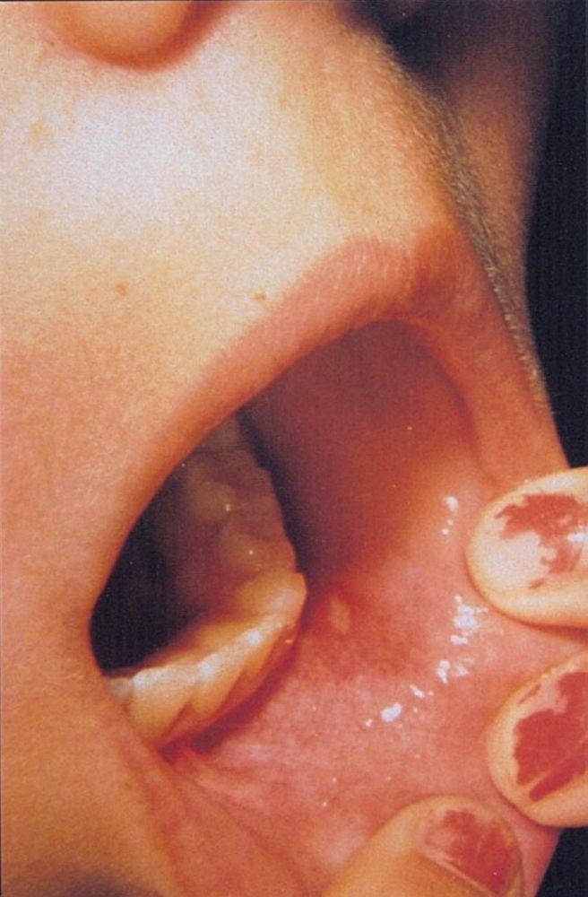 Maladie pieds-mains-bouche (lésions orales)