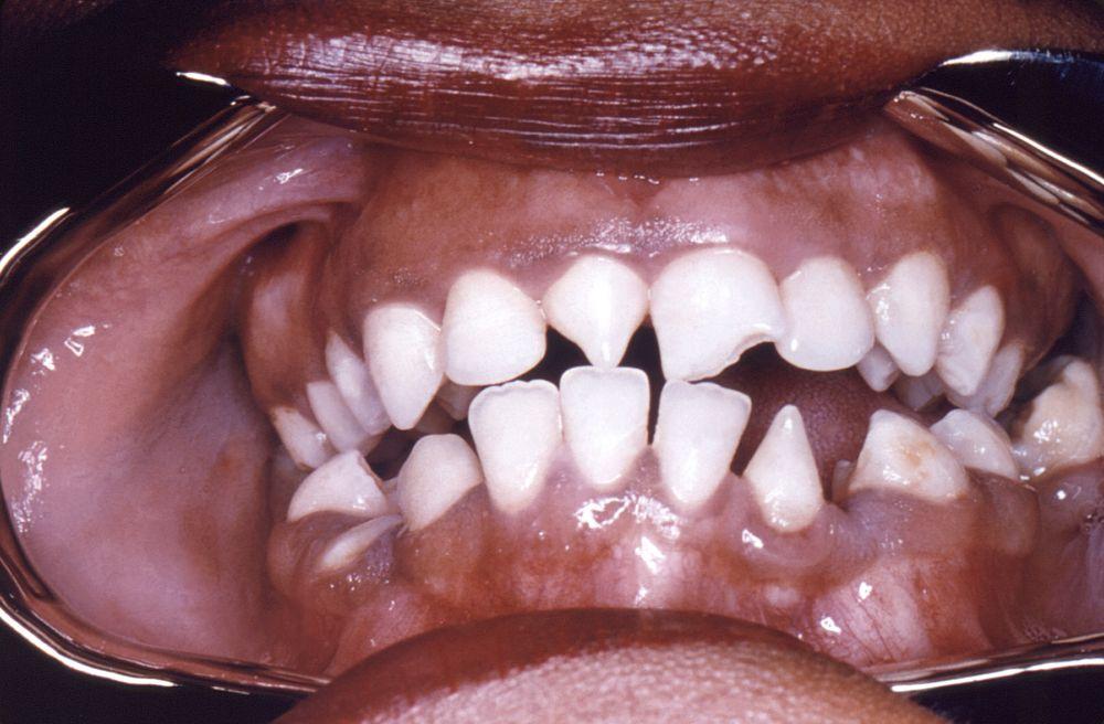 Зубы Гетчинсона