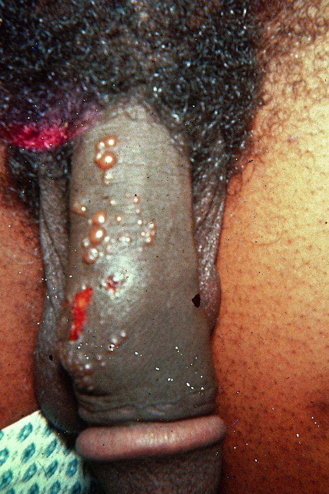 Herpes genital (pene)