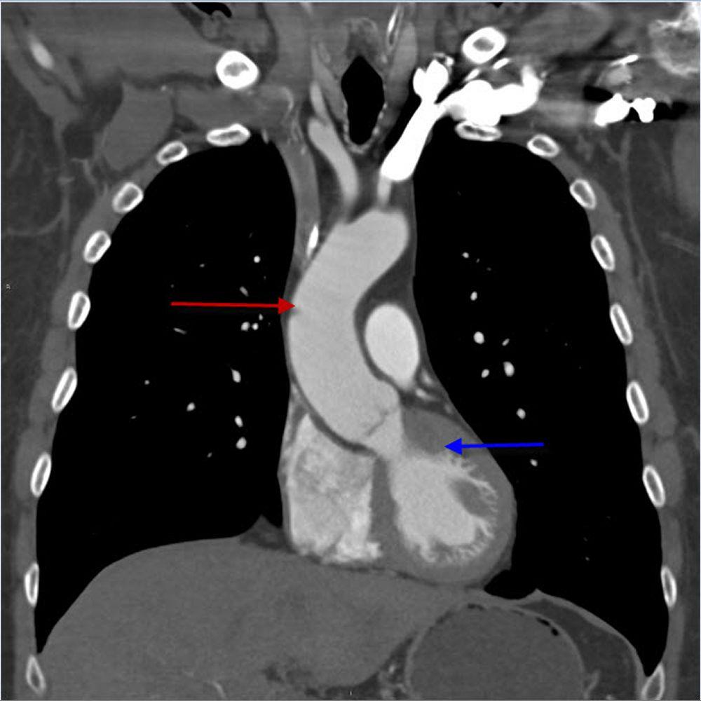 CTA (Coronal View) of Thorax Showing Ascending Thoracic Aorta