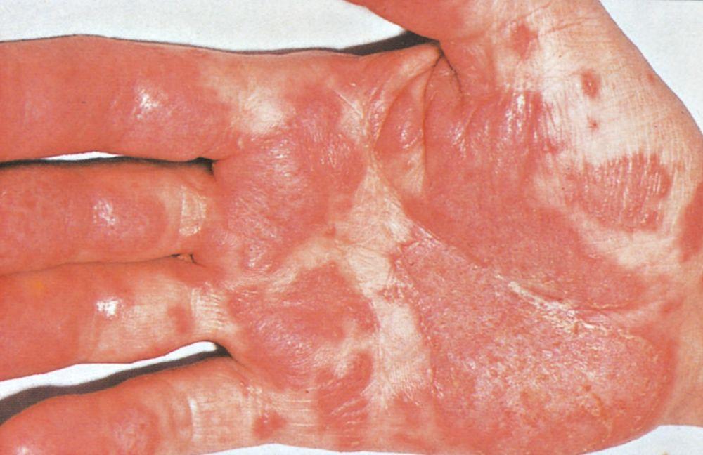 Ceratoderma blenorrágico (palmas das mãos)