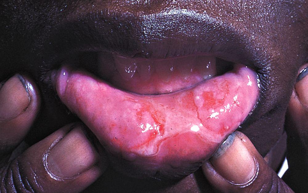 Behçet-Krankheit (orale Läsionen)