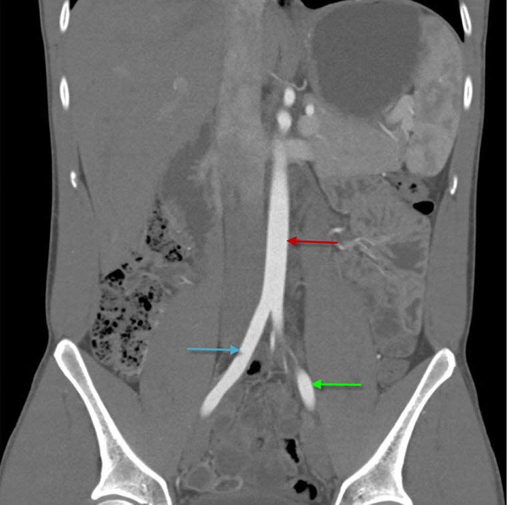 Angiotomografía (ATC) (vista coronal) abdominal que muestra la aorta abdominal