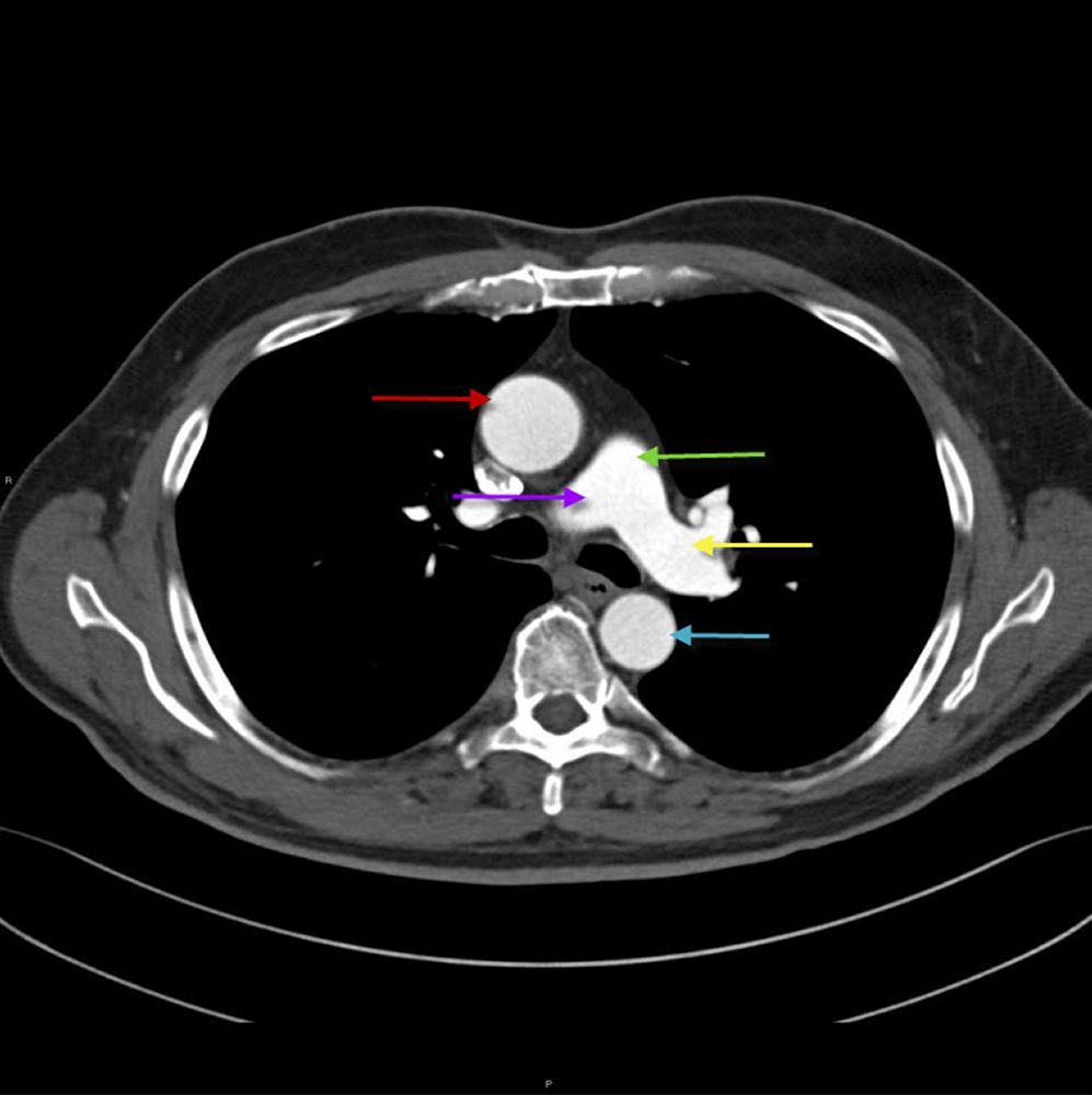 TC de tórax mostrando a anatomia da aorta e artéria pulmonar