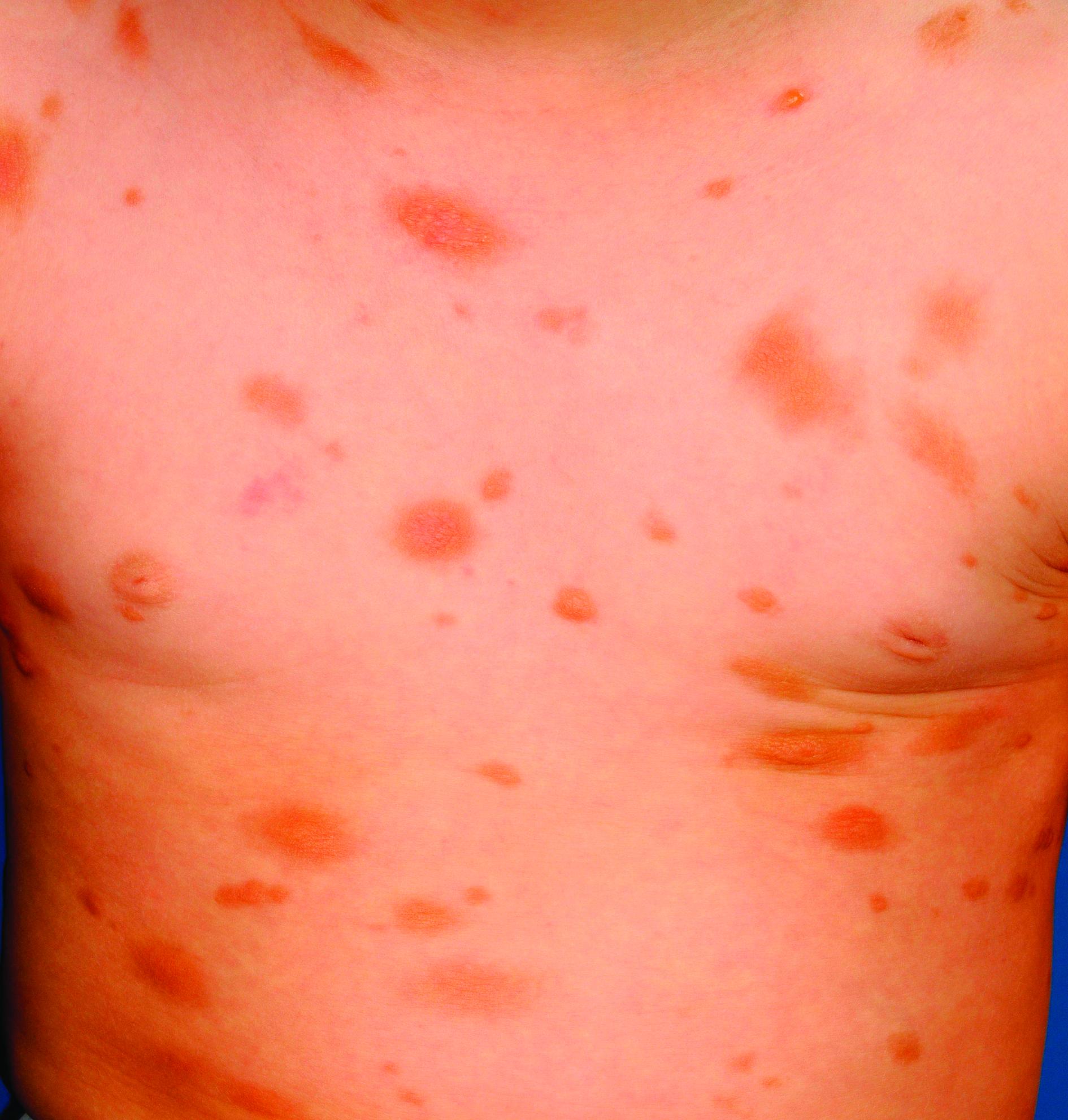 色素性蕁麻疹（胸部）