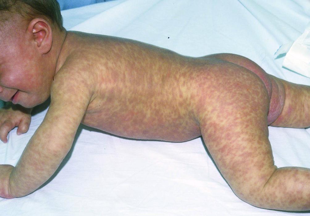 色素性蕁麻疹（乳児）