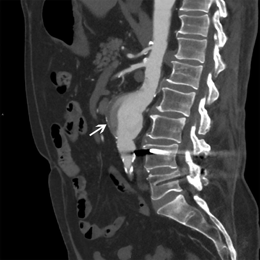 Aneurisma aórtico abdominal (tomografía computarizada)