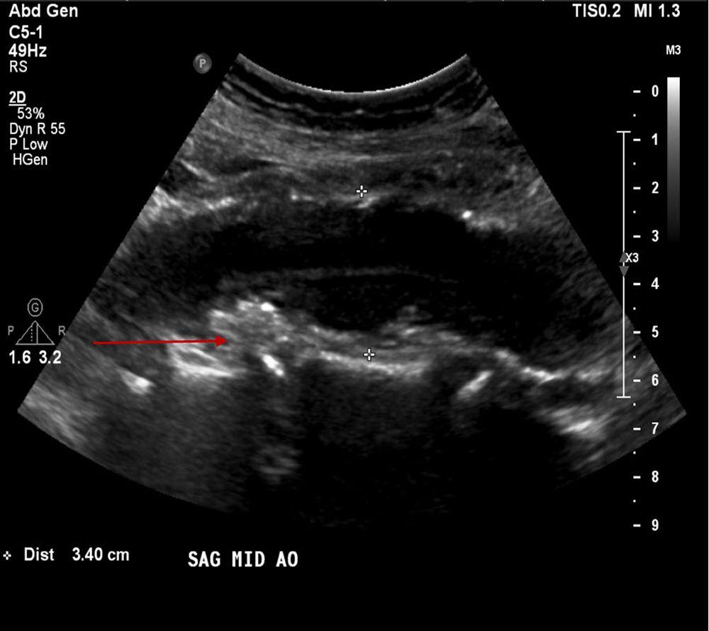 Aneurisma aórtico abdominal (ecografía)