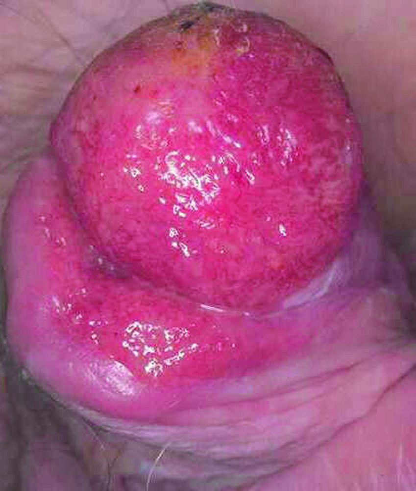 Eritroplastia de Queyrat con carcinoma del pene