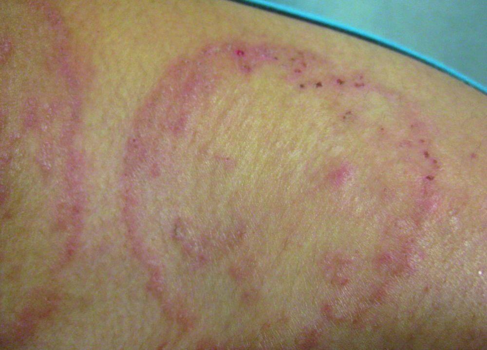 Tinea Corporis With Extensive Central Clearing